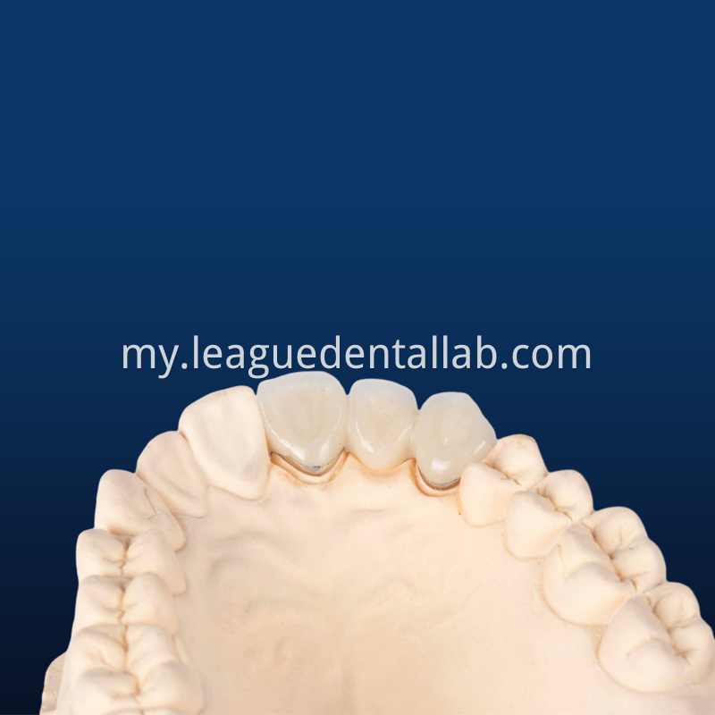 PFM,Metal crown,Fixed metal crown